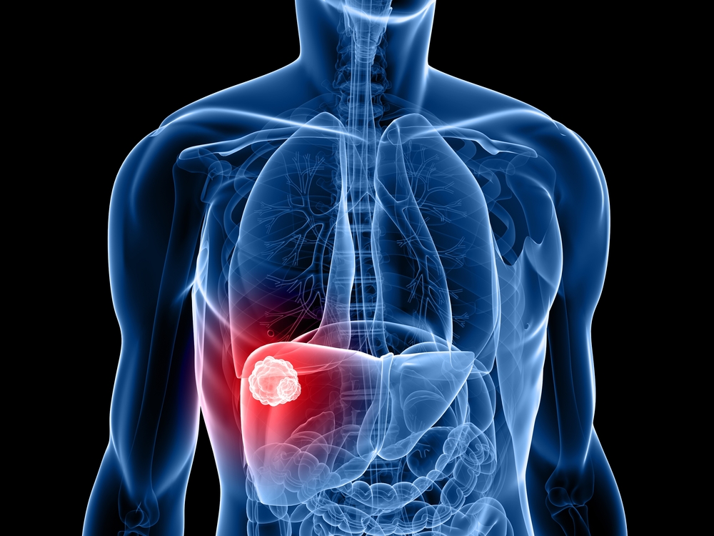Colorectal Cancer Metastasis Associated With Liver Metabolic Processes