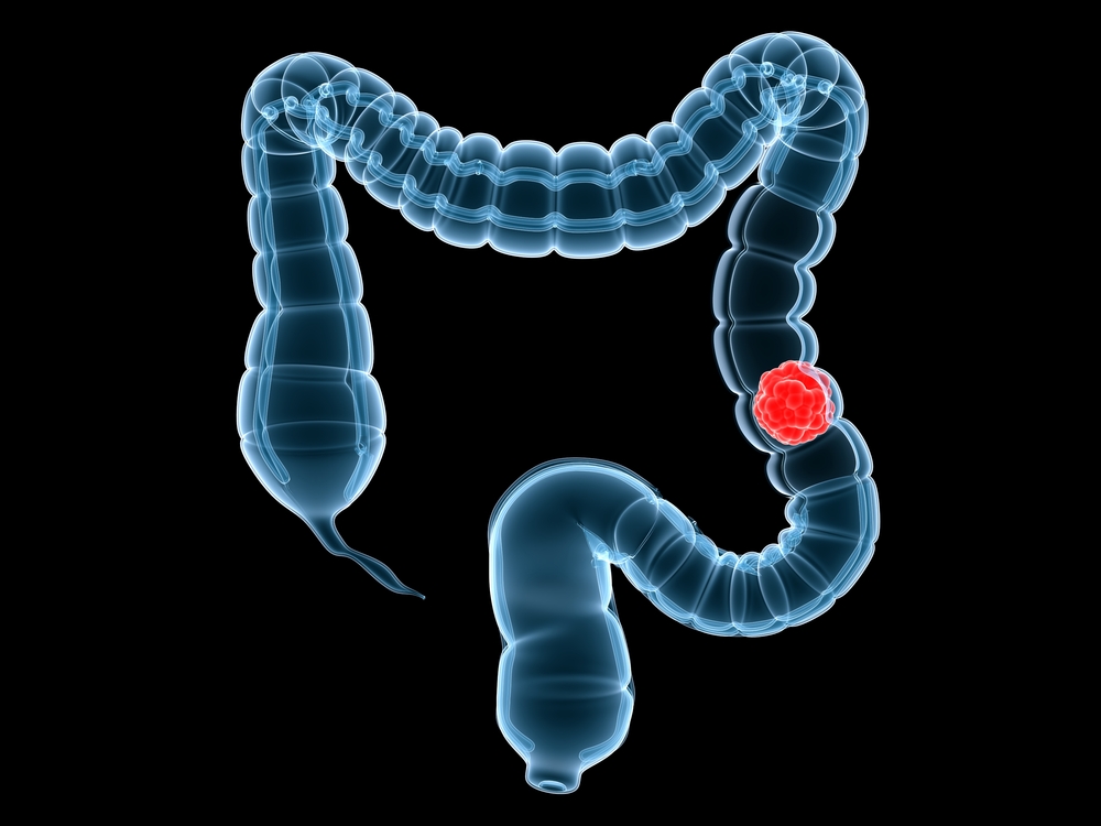 Promising Antibody Therapy for Resistant Advanced Colorectal Cancer