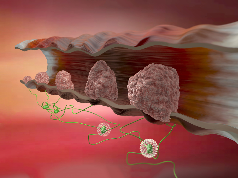 Colon Cancer and Immune System’s Response to Tumor Development