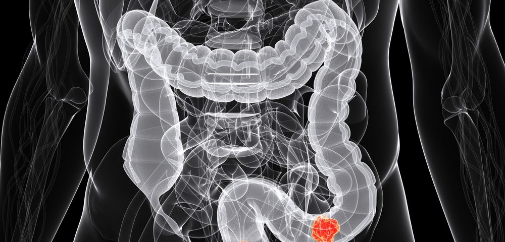 Left-sided Colon Cancer Associated with Better Prognosis than Right-sided, Study Finds