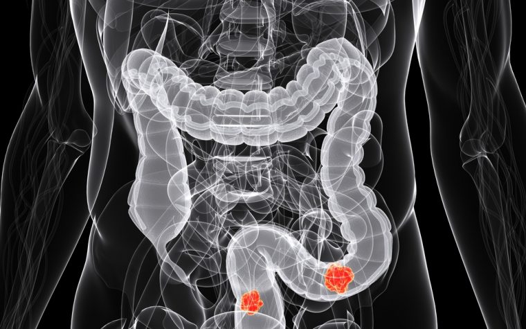 left-sided colon cancer