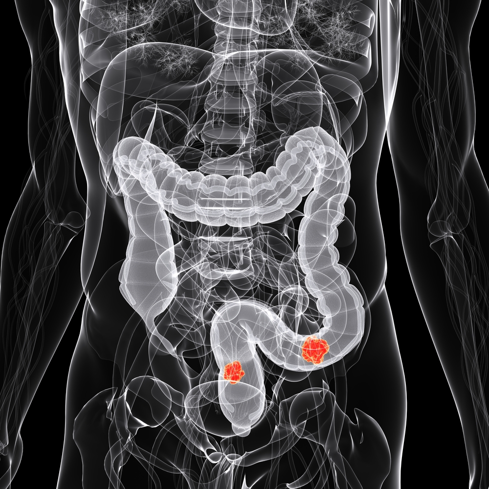 study-left-sided-colon-cancer-associated-with-better-prognosis