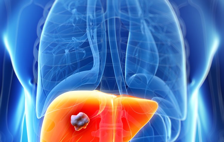 colon cancer with liver metastasis