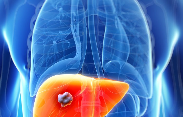 New Biomarker Could Improve Treatments for Colorectal Cancer with Liver Metastasis