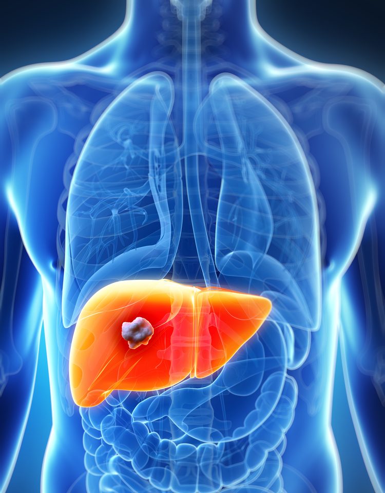 Metastatic cancer from colon to liver